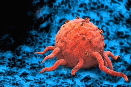 te-bao-ung-thu tế bào ung thư