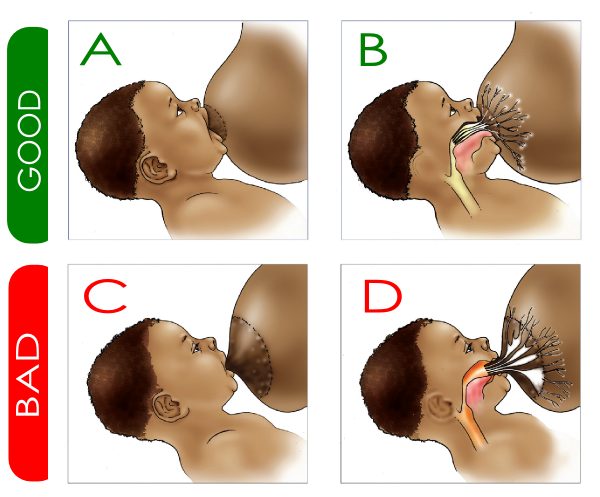 3.2. Giữ tư thế đúng khi cho trẻ sơ sinh bị nôn trớ 1