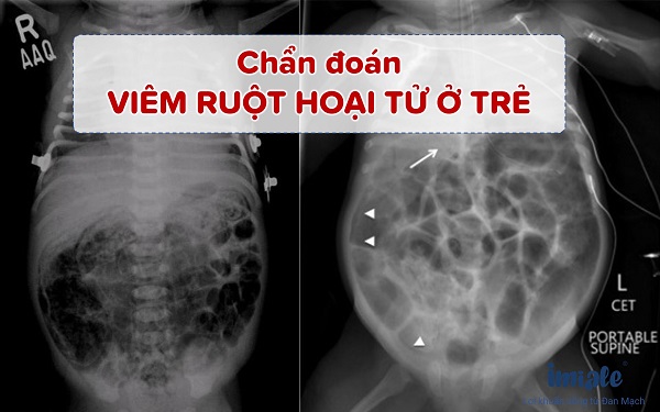 3. Triệu Chứng Của Viêm Ruột