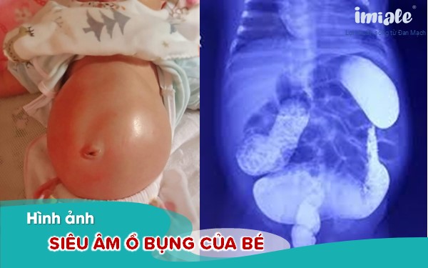 Hình ảnh siêu âm ổ bụng của trẻ