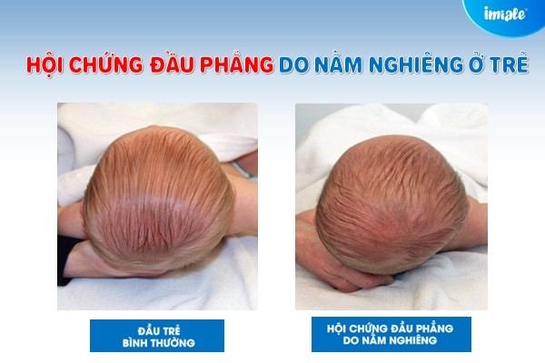 trẻ sơ sinh nằm nghiêng bị đầu phẳng